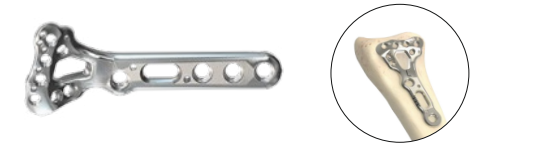Locking Volar Distal Radius Standard